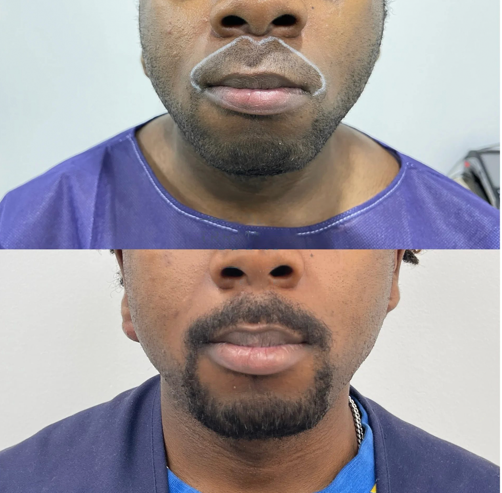 Beard & Eyebrow Transplants